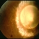 Toxocariasis Cyst